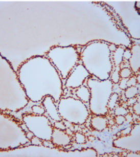 甲状腺转录因子 TTF-1 抗体试剂 免疫组织化学